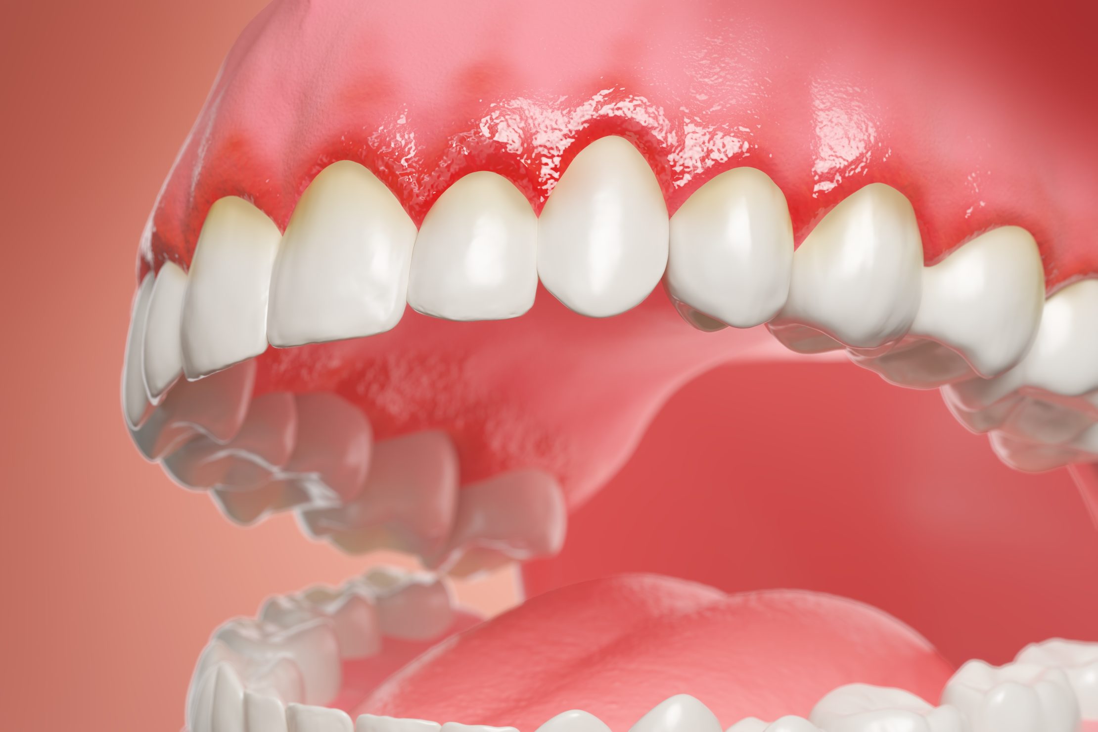 Periodontal Therapy: What It Is and When You Might Need It